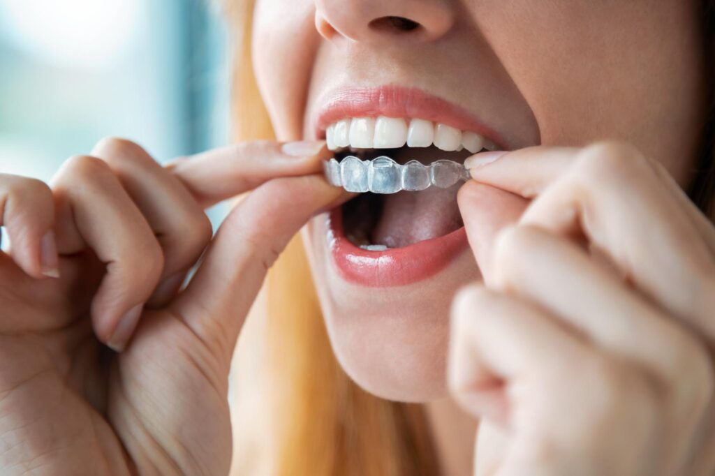 Person placing a clear aligner tray
