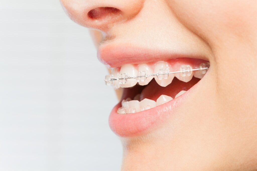 Close-up of a smile with ceramic braces