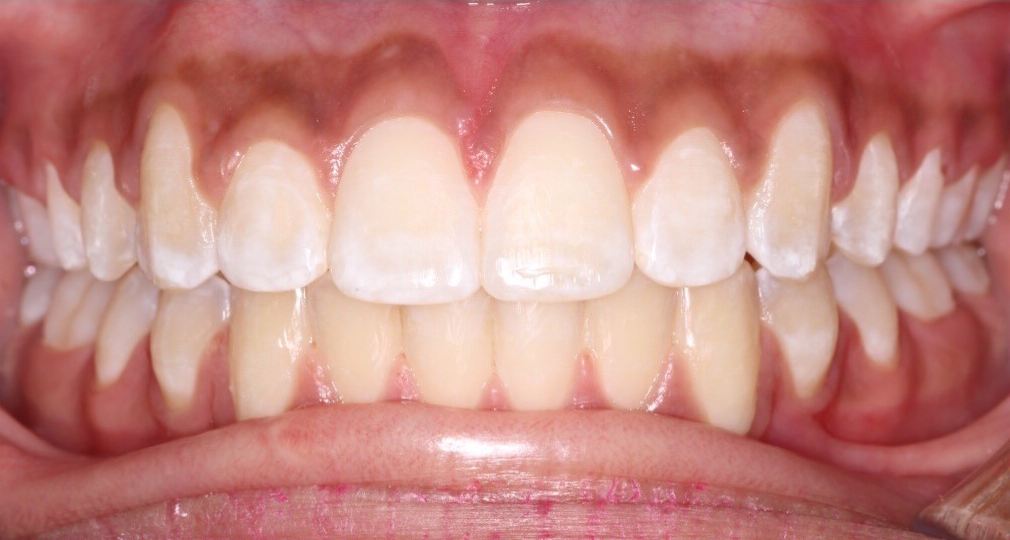 Same patient's smile after orthodontic treatment
