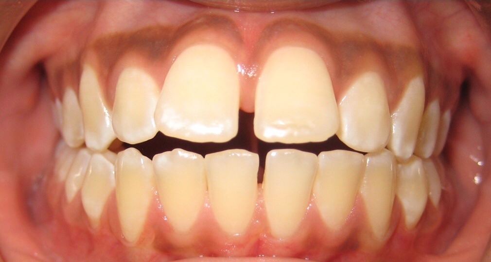 Patient's smile before orthodontic treatment