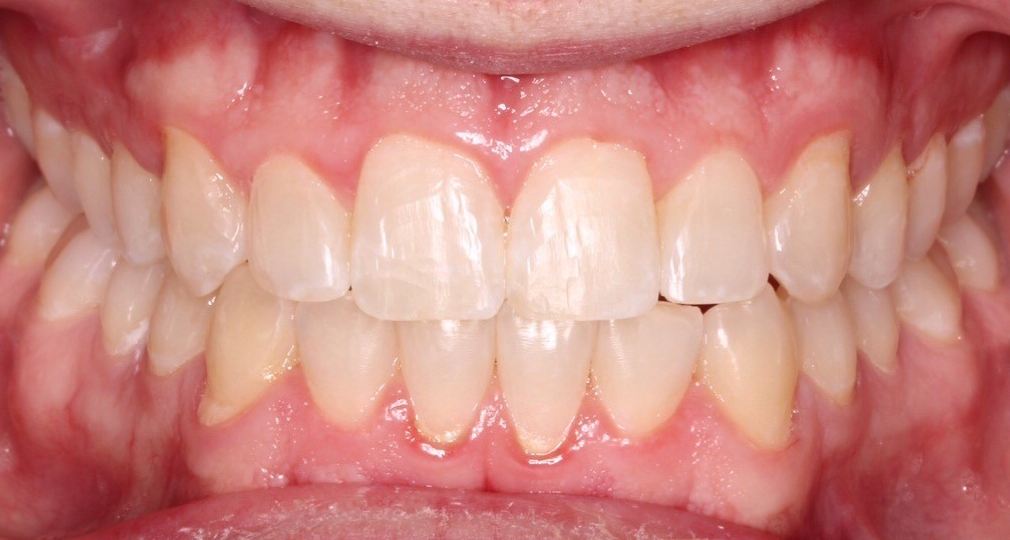 Same patient's smile after orthodontic treatment