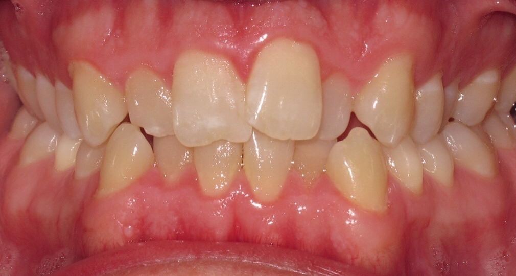Patient's smile before orthodontic treatment