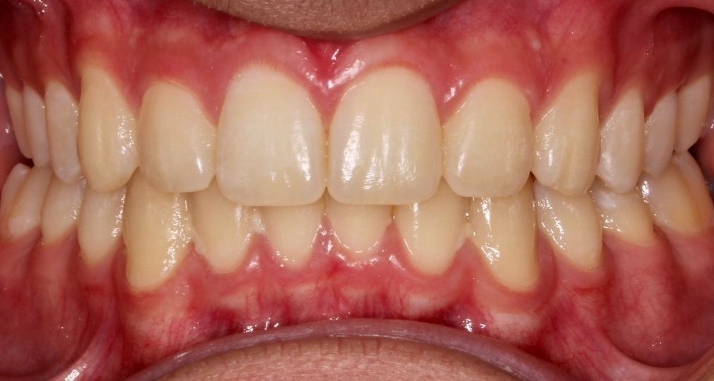Same patient's smile after orthodontic treatment