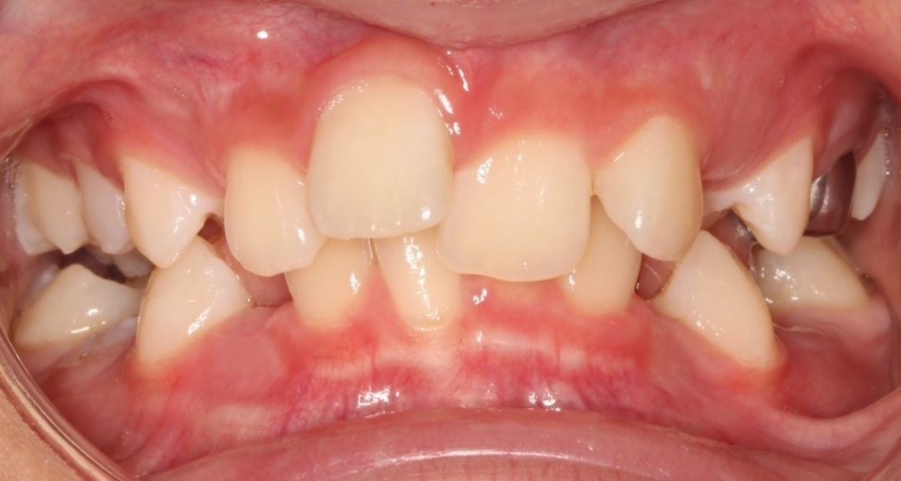 Patient's smile before orthodontic treatment