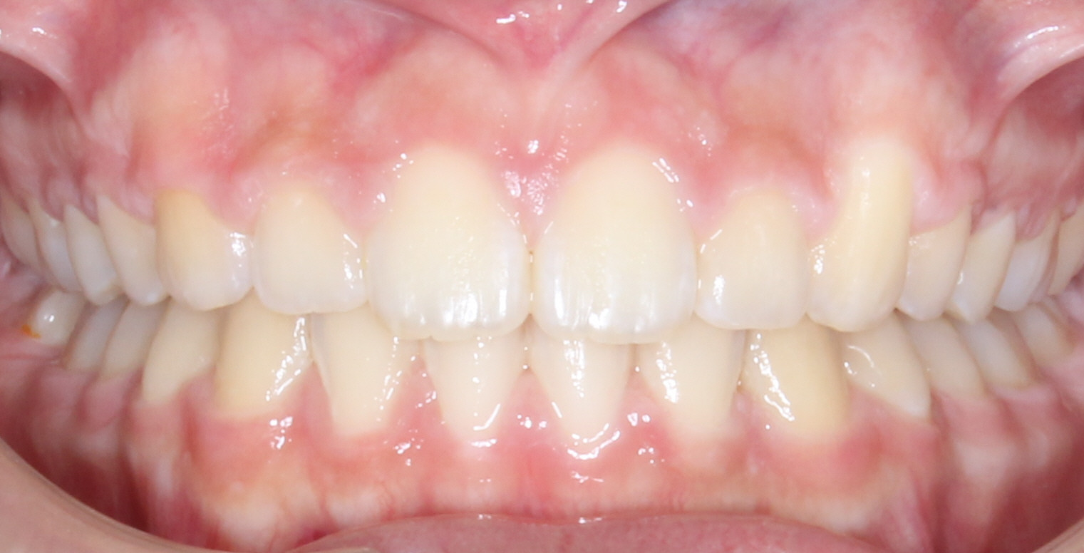 Same patient's smile after orthodontic treatment