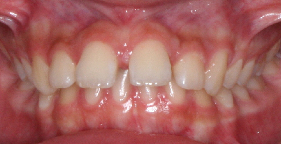 Patient's smile before orthodontic treatment