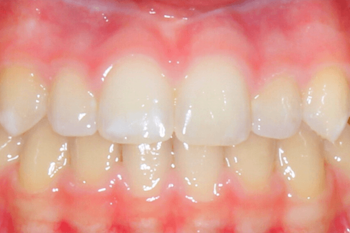 Same patient's smile after orthodontic treatment
