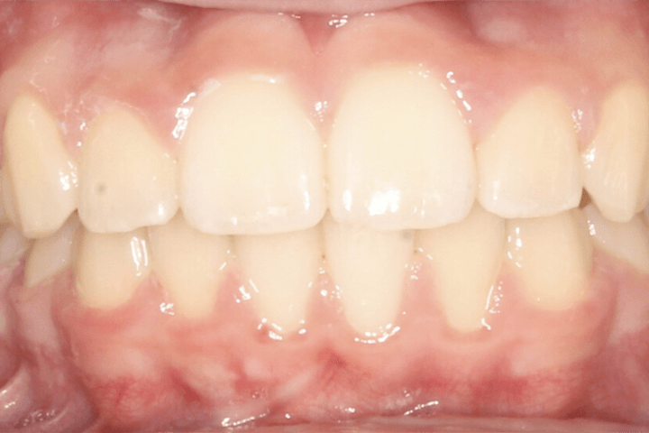 Same patient's smile after orthodontic treatment