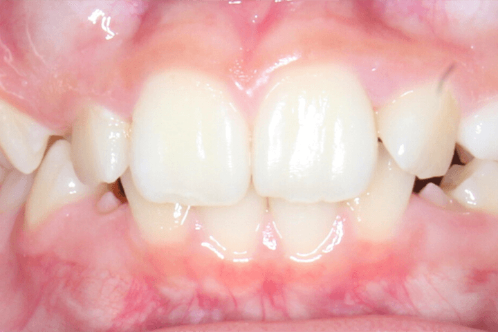 Patient's smile before orthodontic treatment