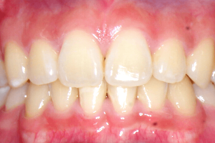 Same patient's smile after orthodontic treatment