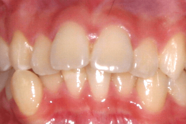 Patient's smile before orthodontic treatment