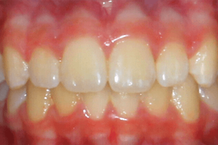 Same patient's smile after orthodontic treatment
