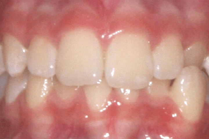 Patient's smile before orthodontic treatment