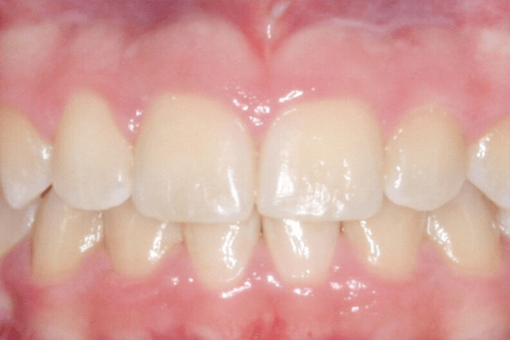 Same patient's smile after orthodontic treatment
