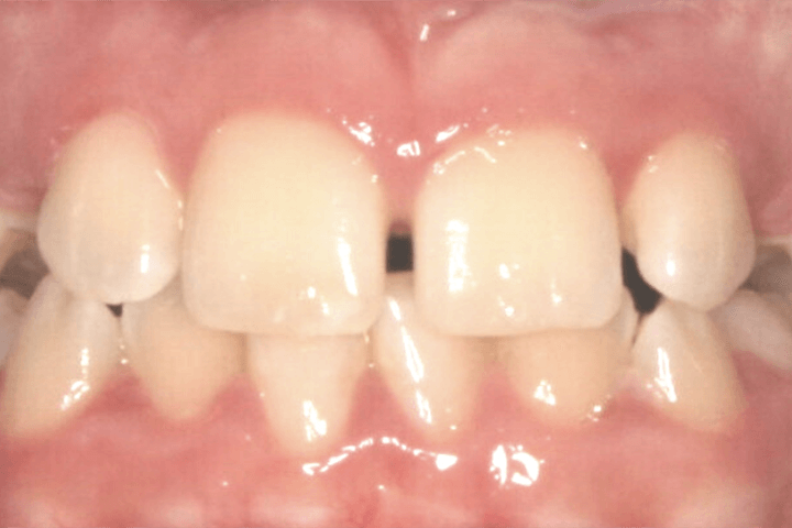Patient's smile before orthodontic treatment