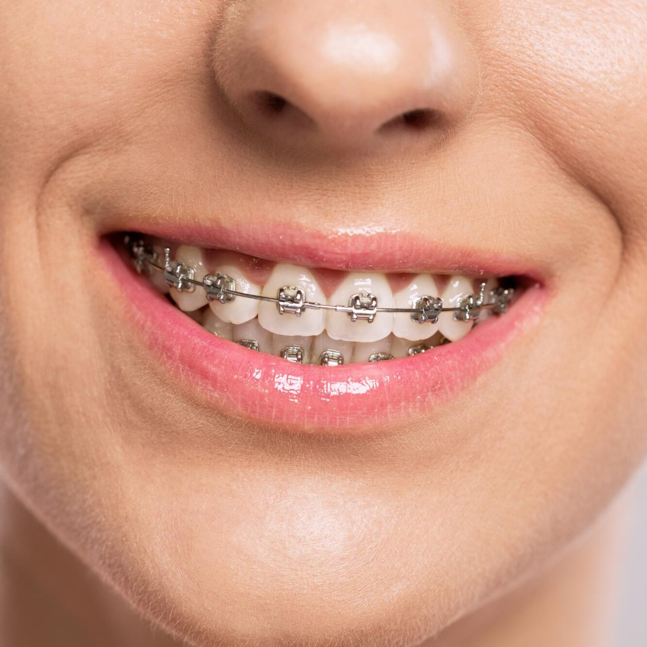 Close-up of metal braces on a patient's upper teeth