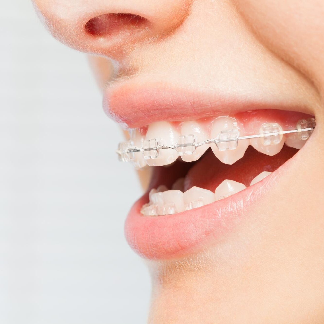 Close-up of a smile with ceramic braces